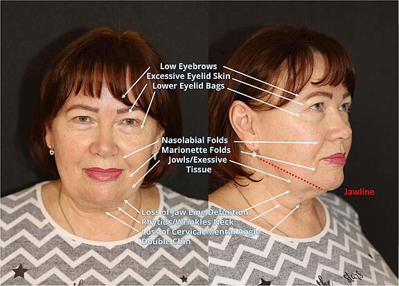 What signs of aging may be present?