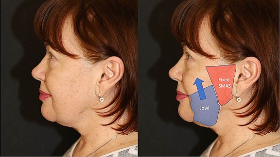 How does the extended deep plane facelift restore the facial anatomy of years past?